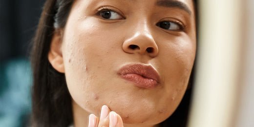 Sneaky Causes of Pimples and How to Get Rid of Them.