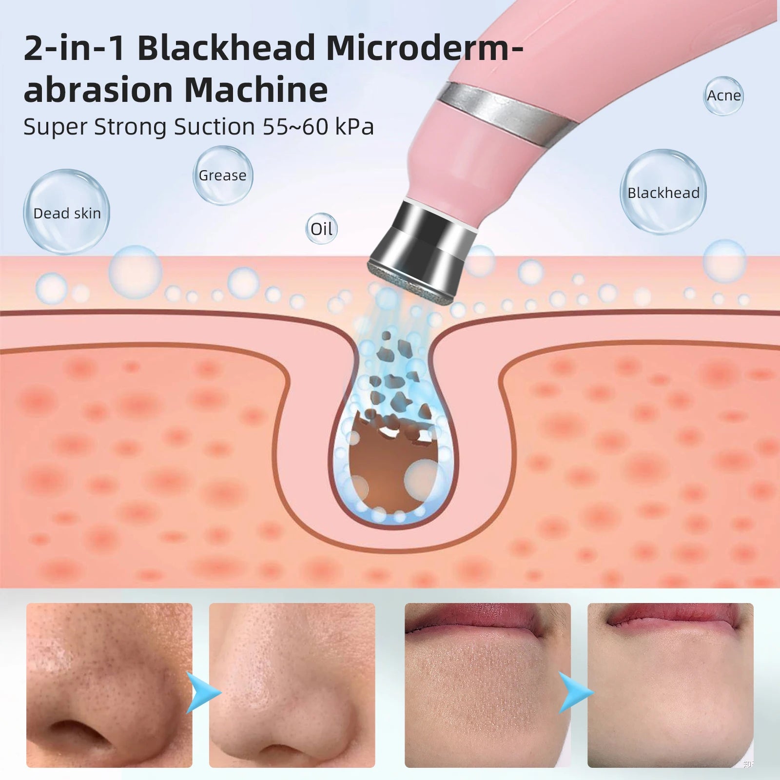 2 in 1 Portable Microdermabrasion Exfoliator & Blackhead Suction Device.