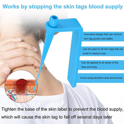 Skin Tag Removal Kit - Radiance Revolution - Default Title - Tag Removal - Generic